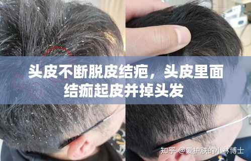 头皮不断脱皮结疤,头皮里面结痂起皮并掉头发